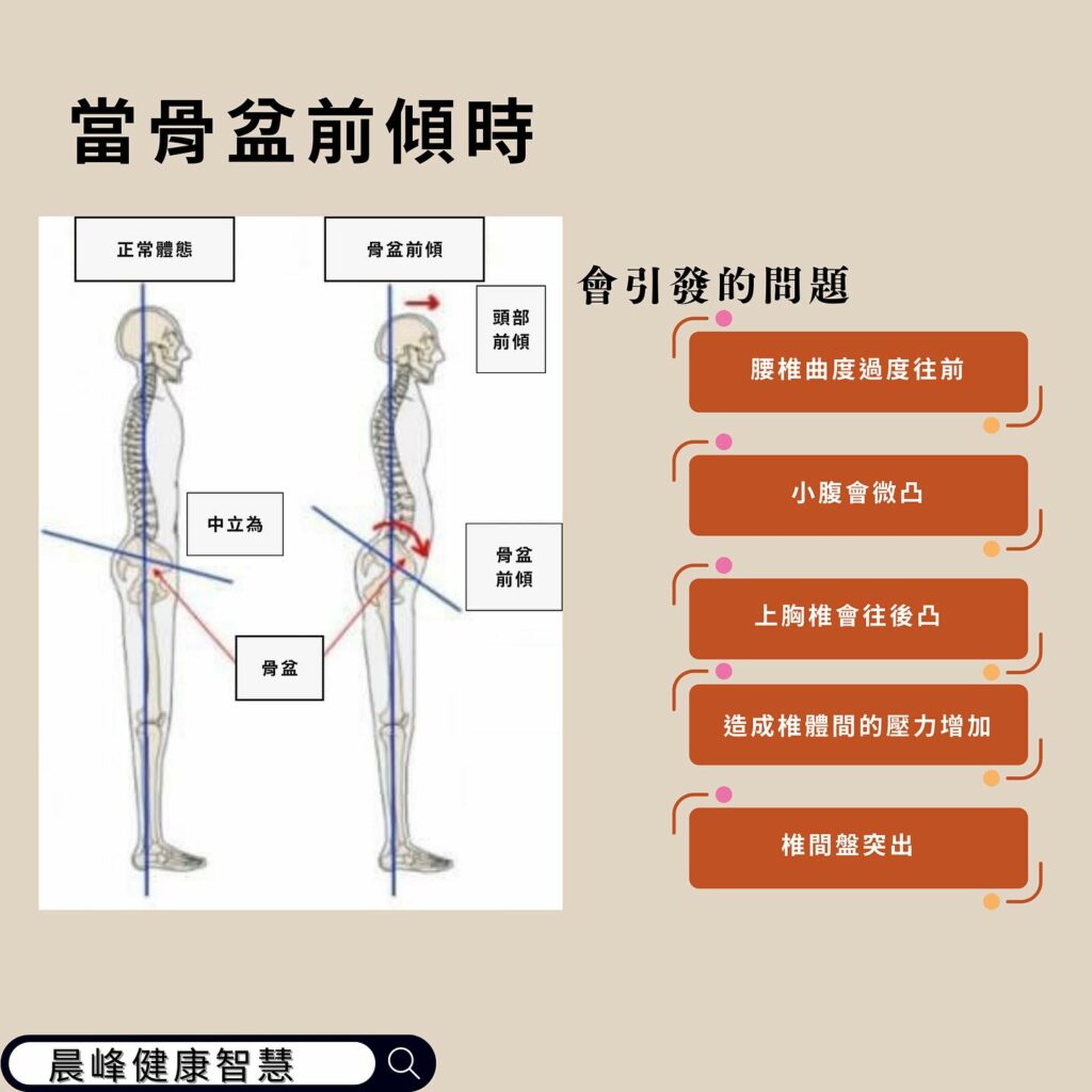 為什麼站久後腰會不舒服？跟骨盆前傾有關 - 晨峰美式整復